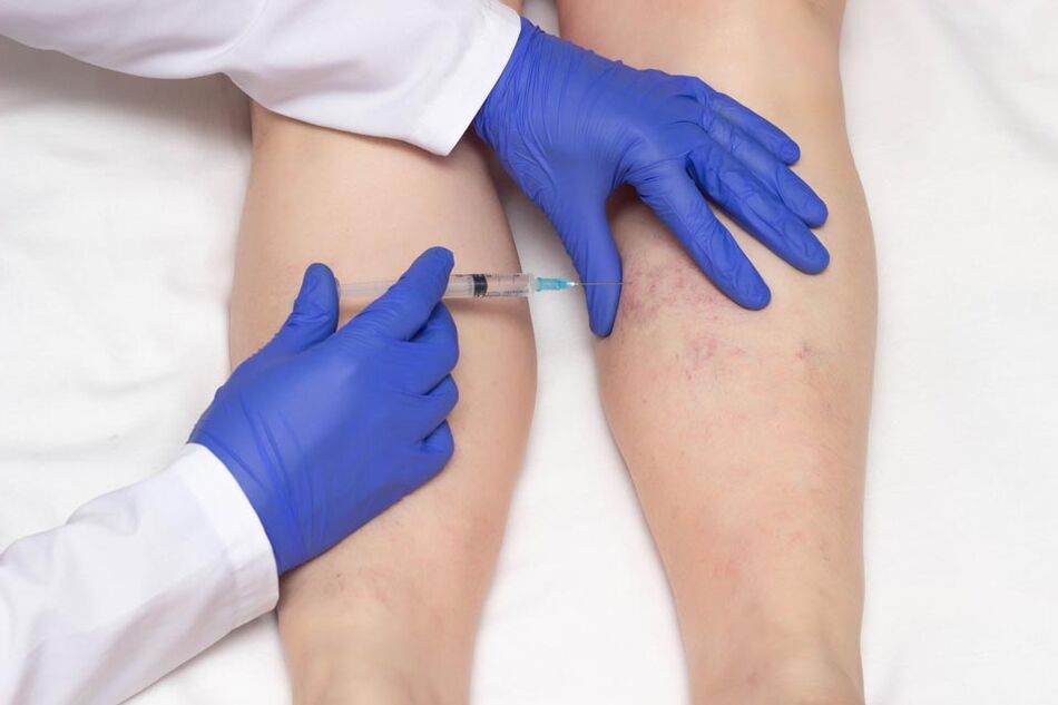 A escleroterapia é um método de tratamento de varizes
