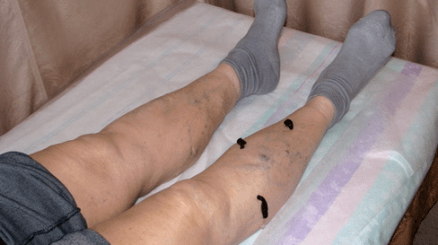 tratamento de varizes com sanguessugas
