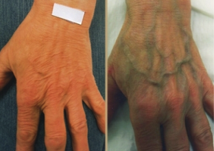causas de veias varicosas nas mãos