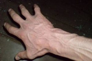 métodos de tratamento de varizes nas mãos