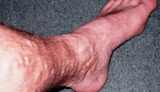 causas de veias varicosas nas pernas em homens