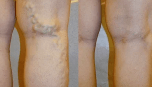 sinais e sintomas de veias varicosas nas pernas em homens