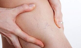 razões para o desenvolvimento de varizes nas pernas