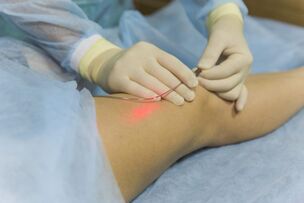 tratamento a laser de veias varicosas a essência do procedimento