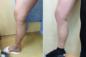 tratamento a laser de veias varicosas antes e depois das fotos