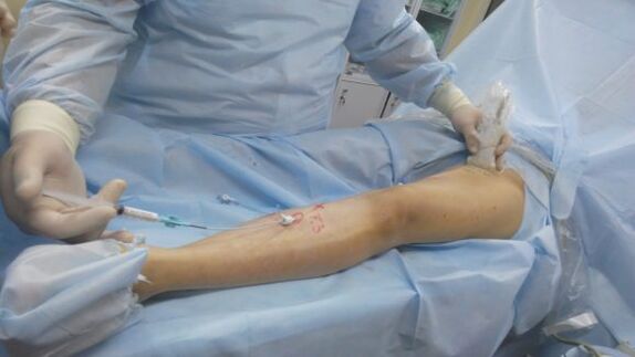 cirurgia para varizes nas pernas
