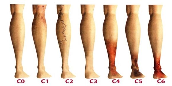 estágios de desenvolvimento de veias varicosas nas pernas