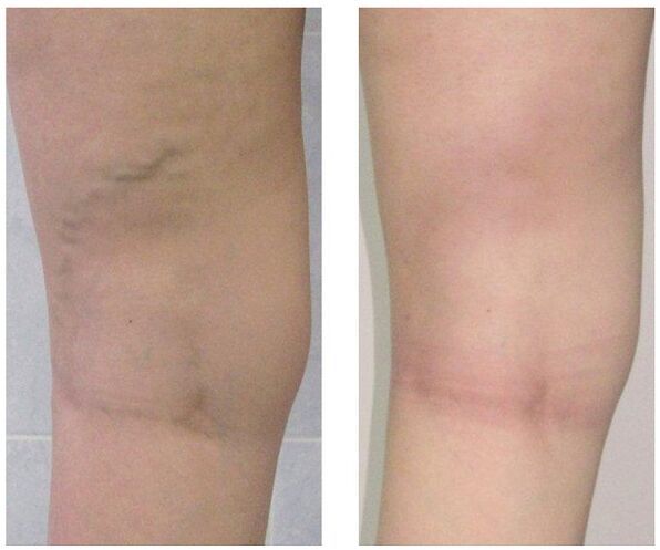 veia na perna antes e depois do tratamento de veias varicosas