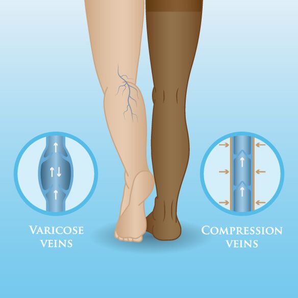 Efeitos das roupas de compressão nas veias varicosas nas pernas
