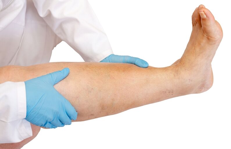 o médico examina a perna com veias varicosas