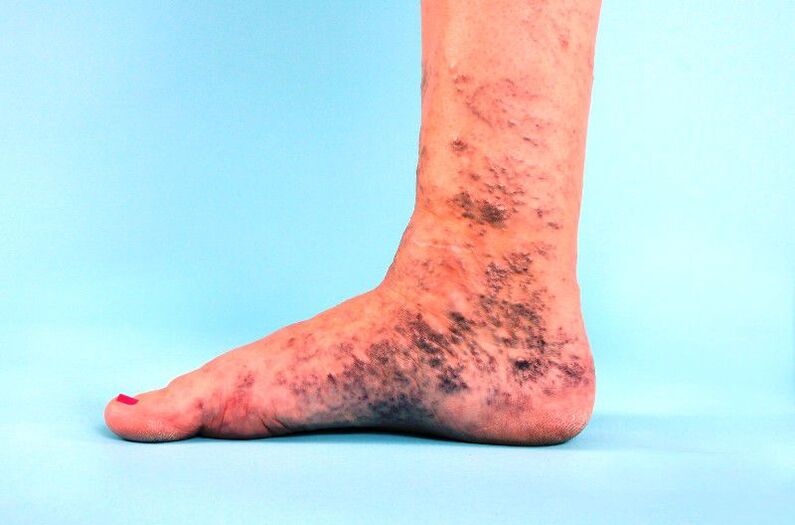 veias varicosas negligenciadas na perna
