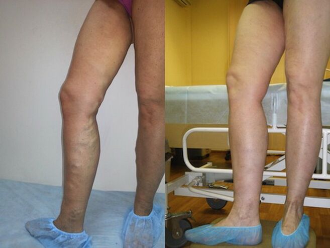 Pernas antes e depois do tratamento a laser de veias varicosas