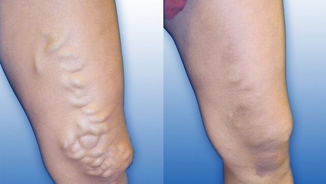 Pernas antes e depois do tratamento de varizes graves