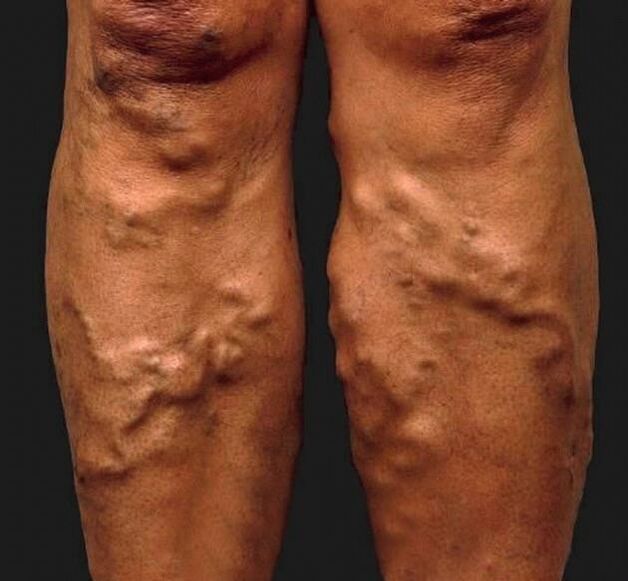 veias varicosas negligenciadas nas pernas