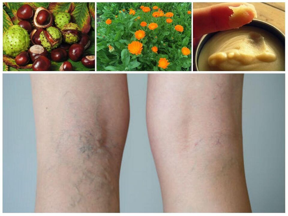 varizes nas pernas e remédios populares para sua prevenção