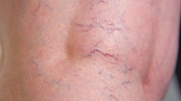 Sinais de veias varicosas reticulares das extremidades inferiores - dilatação de veias finas e malha vascular