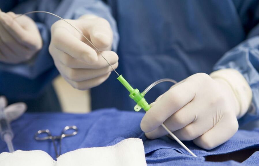tratamento cirúrgico de varizes