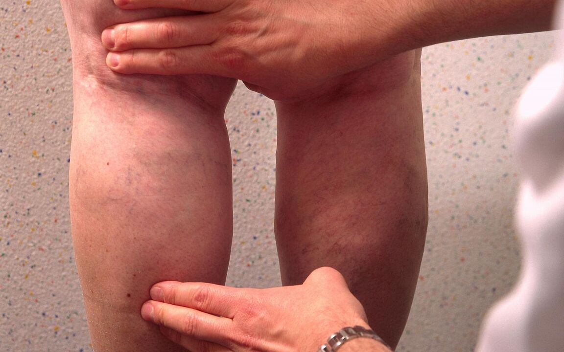 o médico examina as pernas com veias varicosas