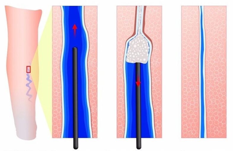 escleroterapia para varizes nas pernas em homens