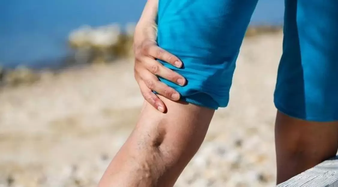 As veias azuis salientes nas pernas são um sinal de varizes